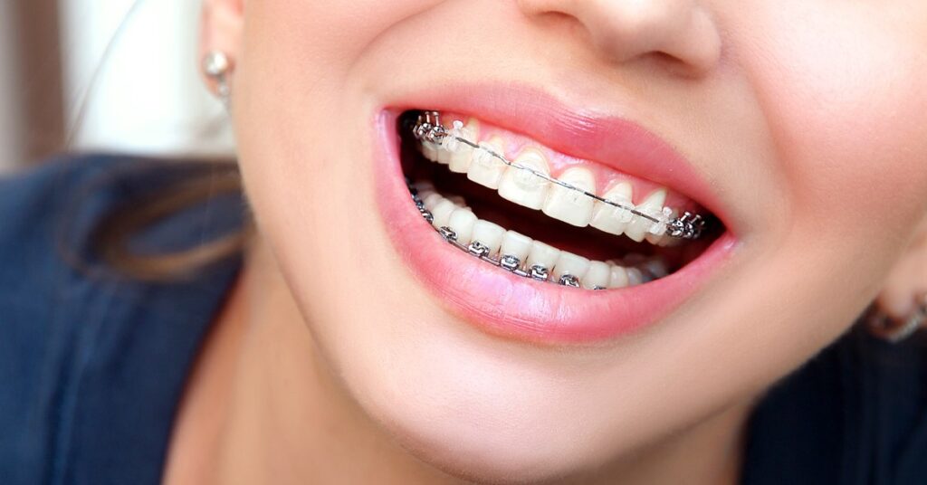 Aparate dentare